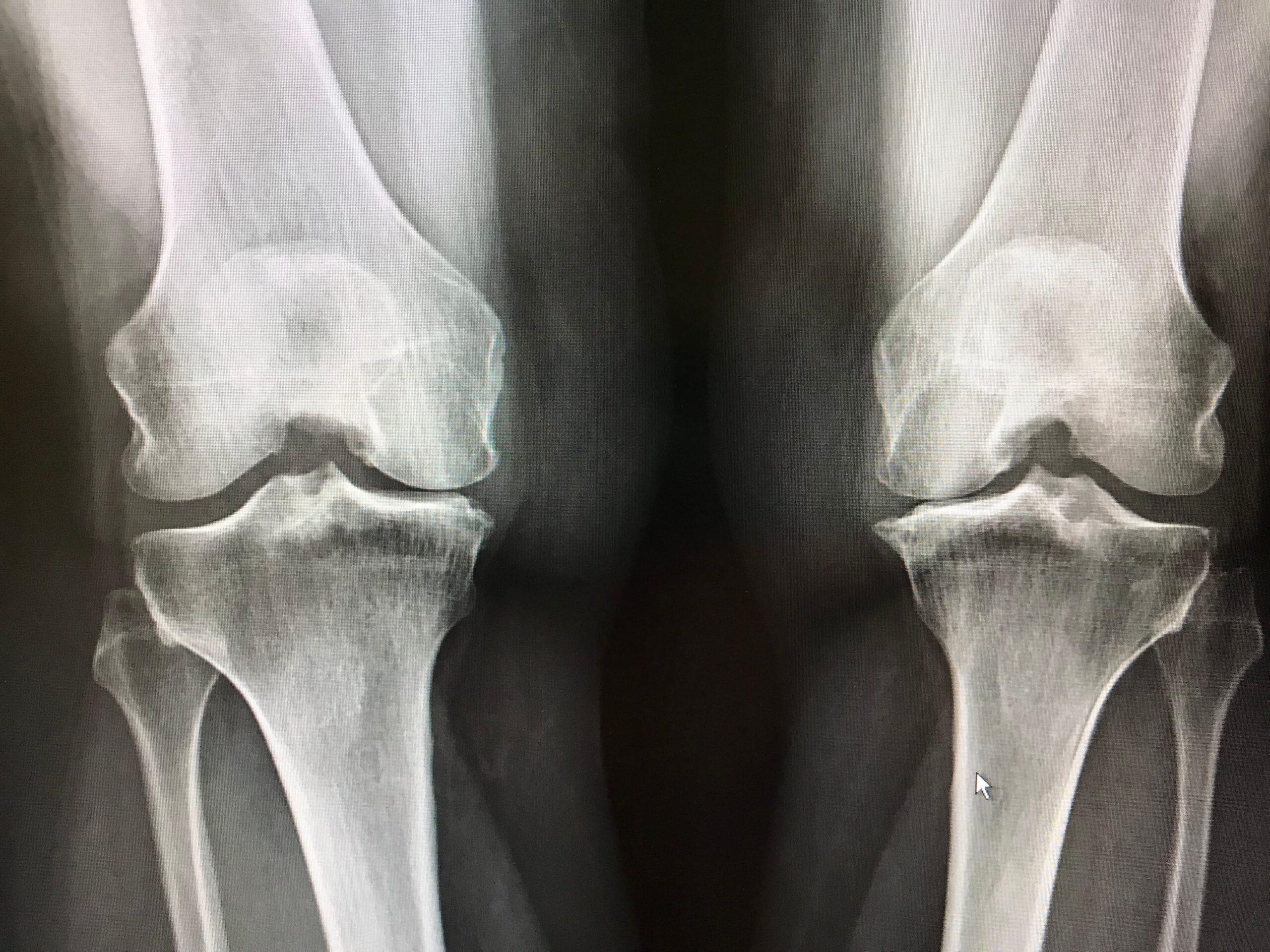 X-ray image of two knees showing bones and joint structure.