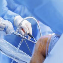 knee-arthroscopy-with-pcl-reconstruction-using-art-2026-01-08-08-15-04-utc 1